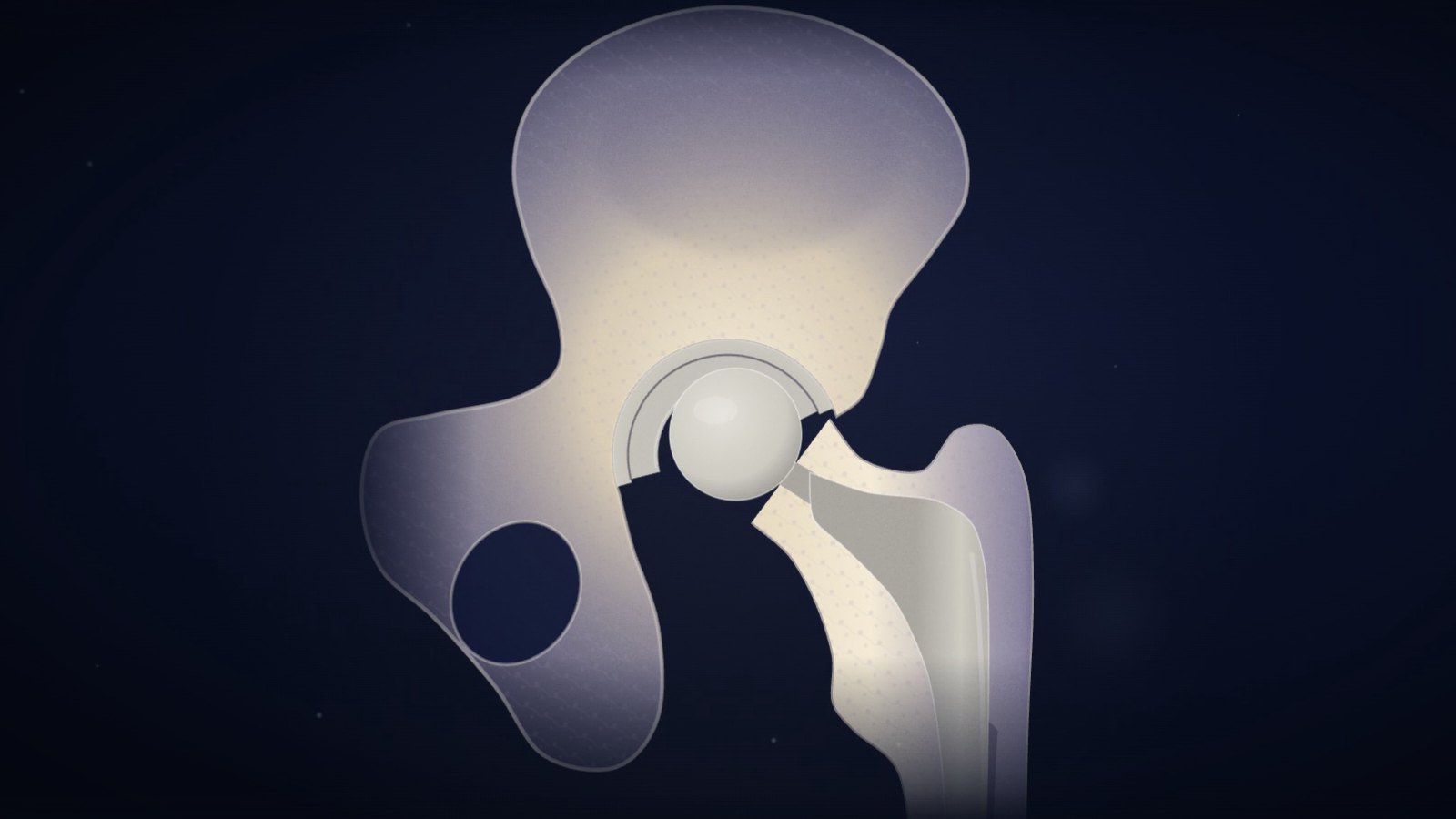 Still from our total hip replacement video: the prosthesis in place, the cup in the pelvis, the stem in the femur and the head between them
