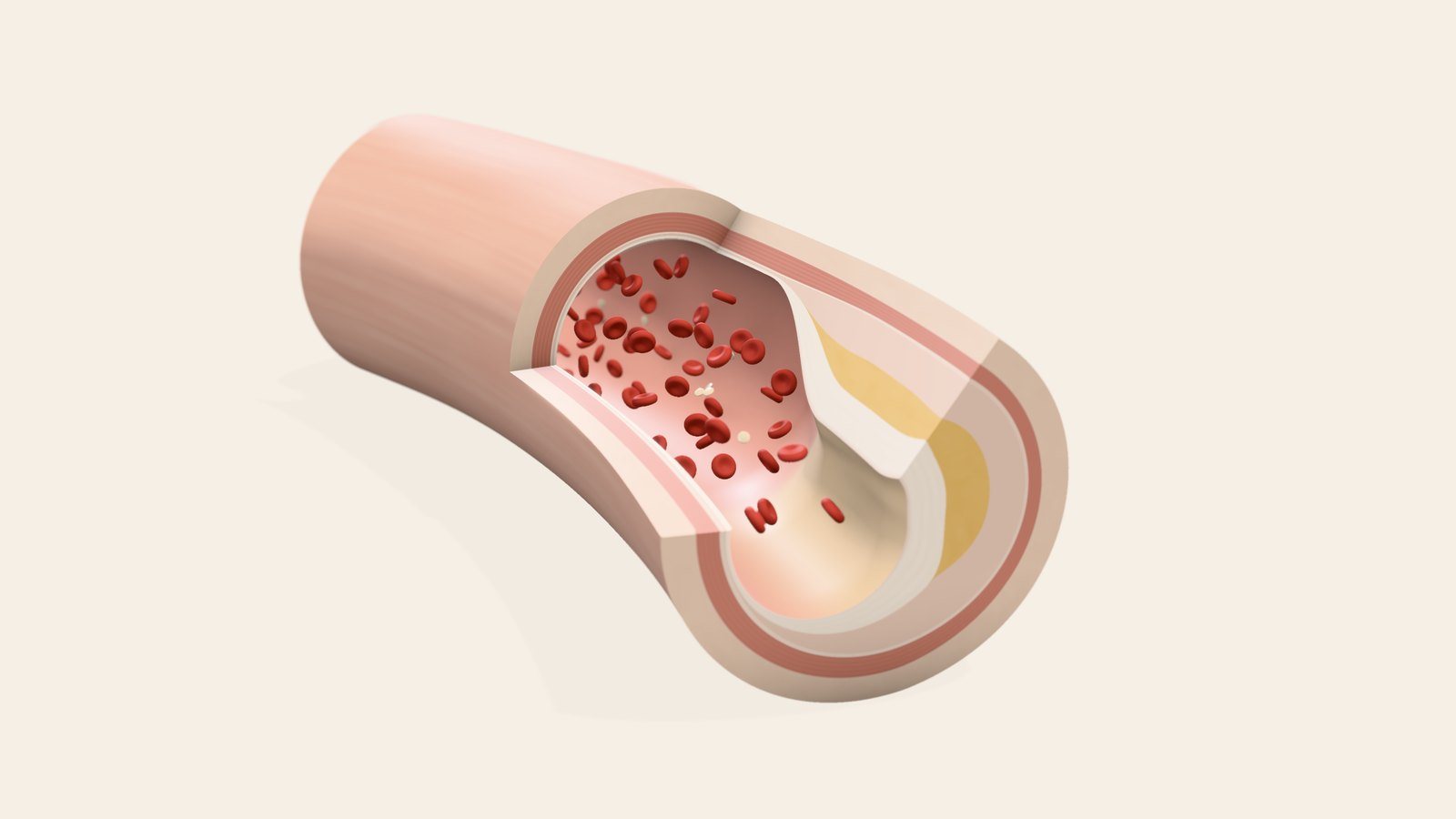 Cross-section of an artery with an atheromatous plaque and flowing blood, 3D illustration