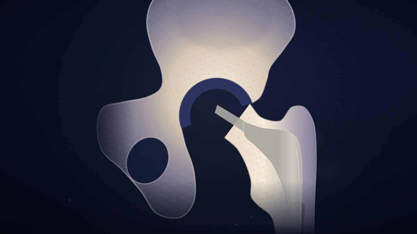 Still from our total hip replacement video, as a 2D illustration: the femoral head has been removed, the cup sits in the acetabulum and the stem has just been fitted into the femur, its neck facing the cup; the prosthetic head is not yet in place