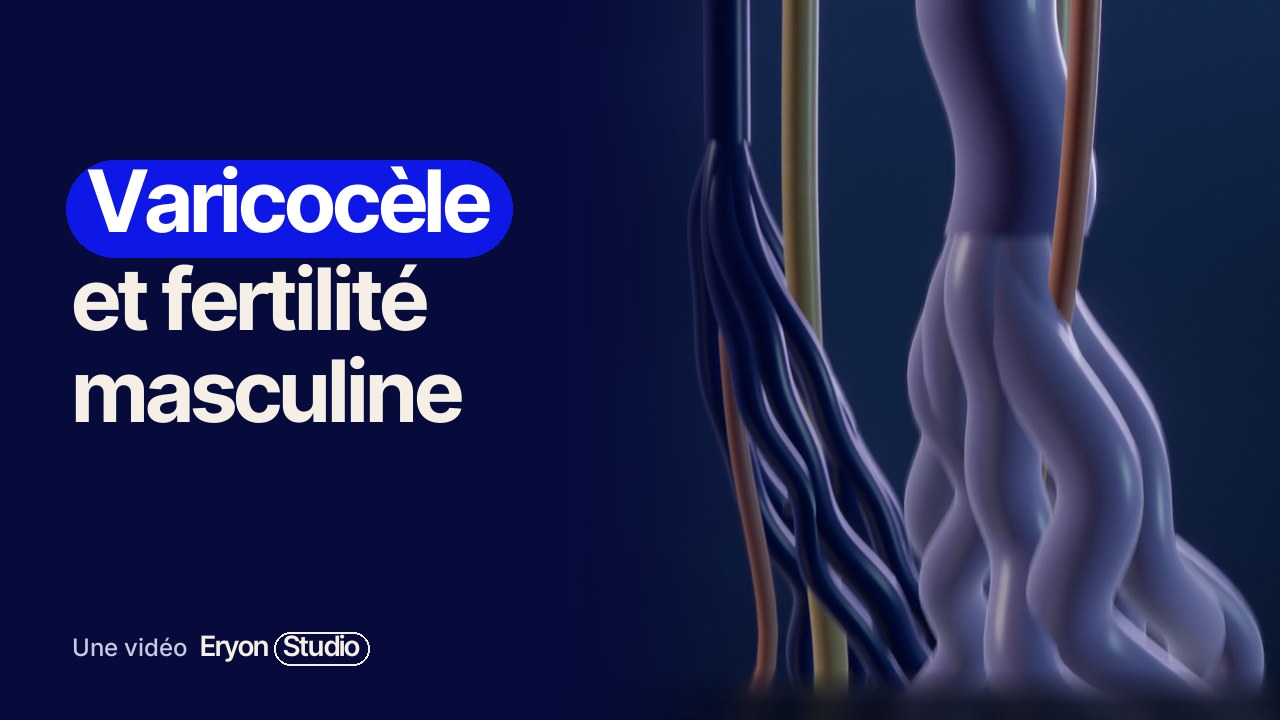 Varicocele and male fertility: symptoms and treatments